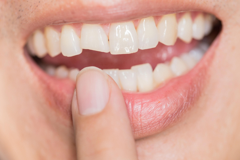 Chipped or Broken Tooth? Here’s What to Do First