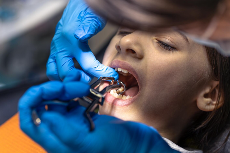 Dental Sealants: A Simple Way to Prevent Cavities